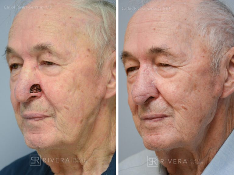 Nose reconstruction from skin cancer removal with Bilobed Rotational flap Miami - Man - Case 16512 - Before and after - Oblique view