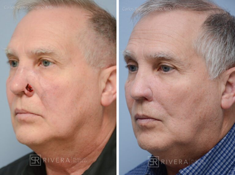 Nose reconstruction from skin cancer removal with Melolabial flap - Man - Case 16513 - Before and after - Oblique view