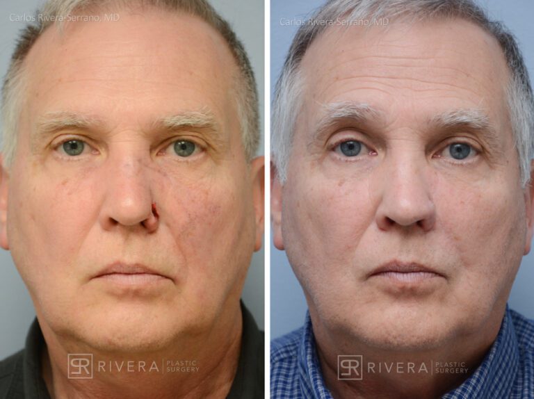 Nose reconstruction from skin cancer removal with Melolabial flap - Man - Case 16513 - Before and after - Frontal view