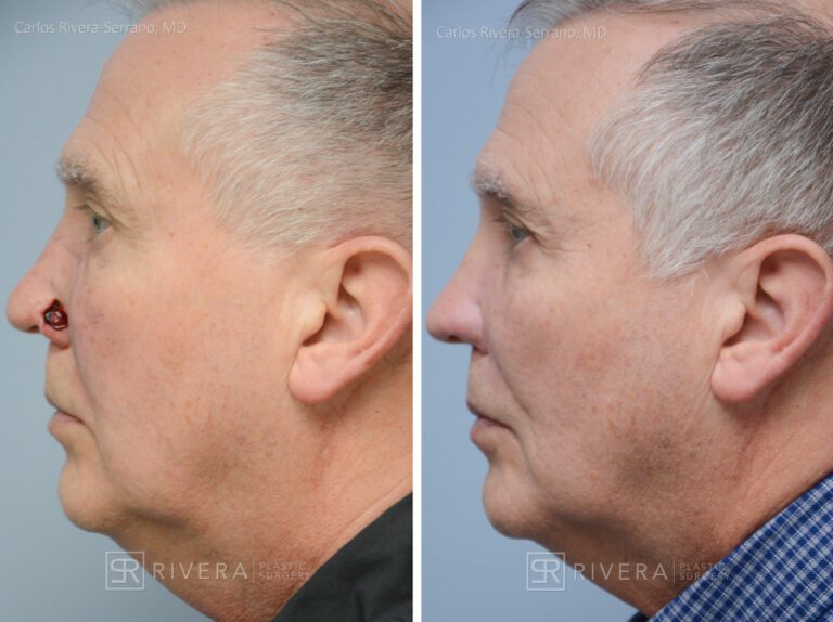 Nose reconstruction from skin cancer removal with Melolabial flap - Man - Case 16513 - Before and after - Lateral view