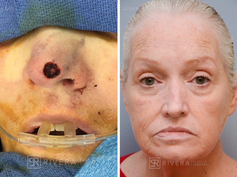 Nose reconstruction from skin cancer removal with Bilobed Rotational flap - Woman - Case 16514 - Before and after - Frontal view