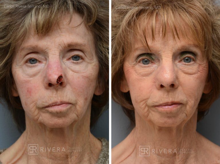 Nose reconstruction from skin cancer removal with Burow's Triangle Displacement flap - Woman - Case 16515 - Before and after - Frontal view