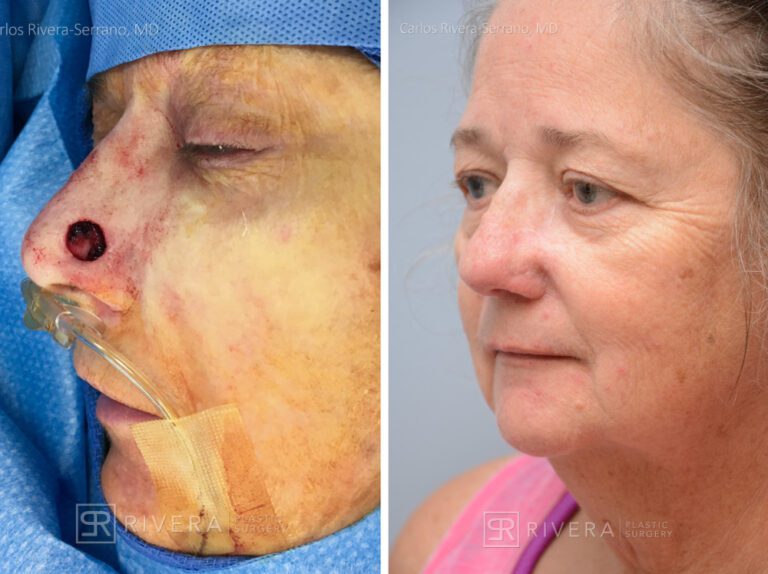 Nose reconstruction from skin cancer removal with Bilobed Rotational flap - Woman - Case 16516 - Before and after - Oblique view