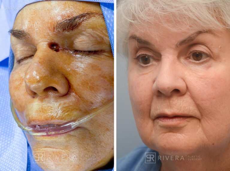 Nose reconstruction from skin cancer removal with Bilobed Rotational flap Miami- Woman - Case 16517 - Before and after - Oblique view