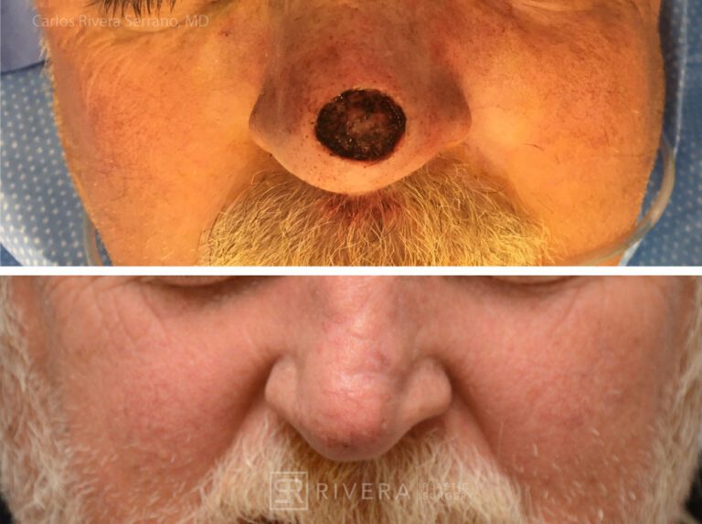 Nose reconstruction from skin cancer removal with Bilobed Rotational flap - Man - Case 16518 - Before and after - Frontal view