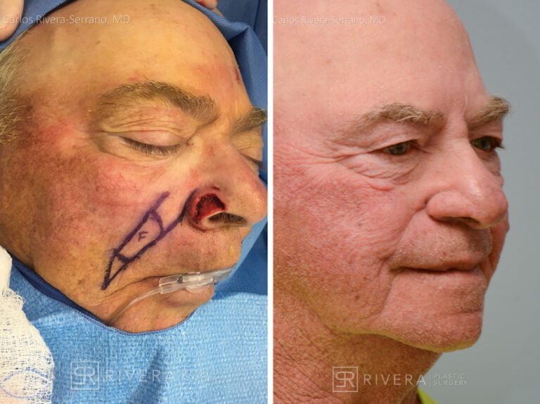Nose reconstruction from skin cancer removal with Melolabial flap - Man - Case 16519 - Before and after - Oblique view