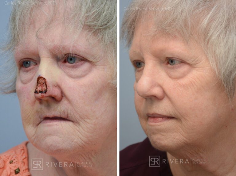 Nose reconstruction from skin cancer removal with Paramedian Forehead flap - Woman - Case 16502 - Before and after - Oblique view