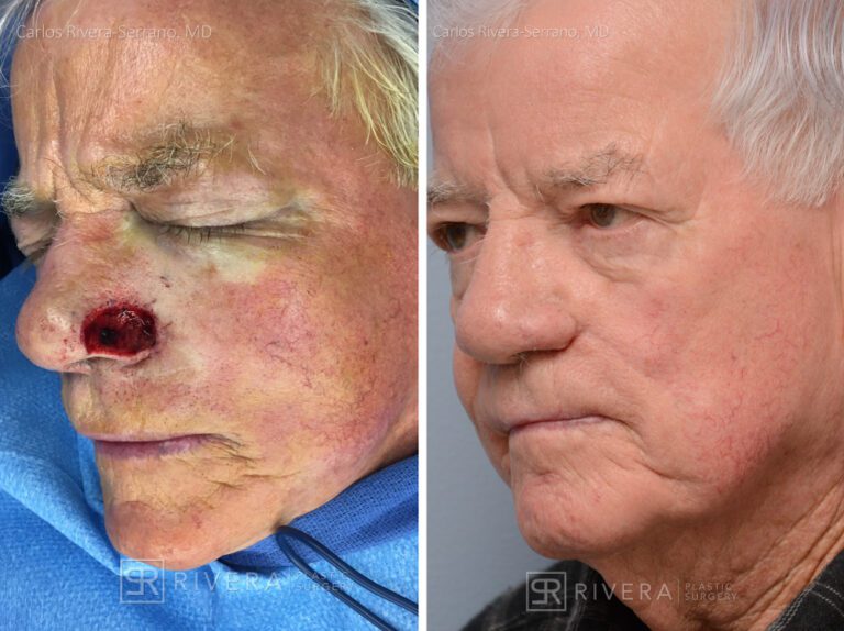 Nose reconstruction from skin cancer removal with Melolabial flap - Man - Case 16520 - Before and after - Oblique view