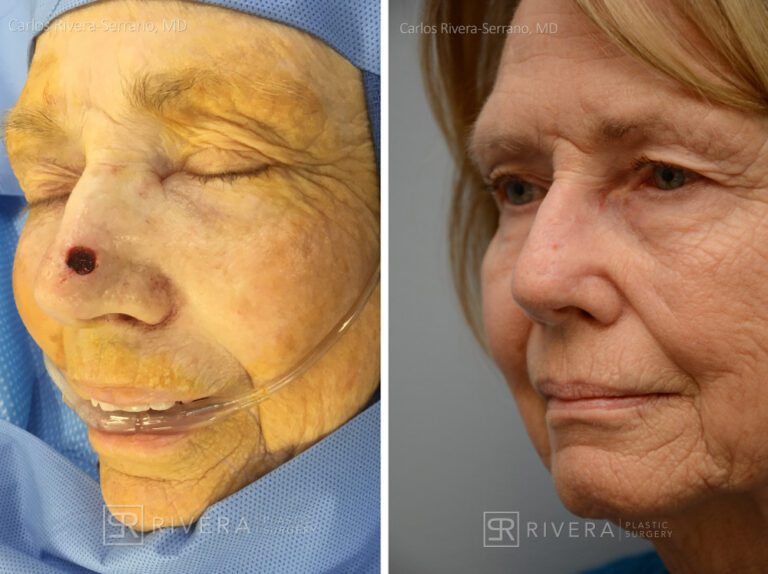 Nose reconstruction from skin cancer removal with Bilobed Rotational flap - Woman - Case 16521 - Before and after - Oblique view