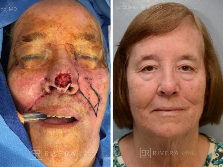 Nasal reconstruction from skin cancer removal with Melolabial flap - Woman - Case 16524 - Before and after - Frontal view