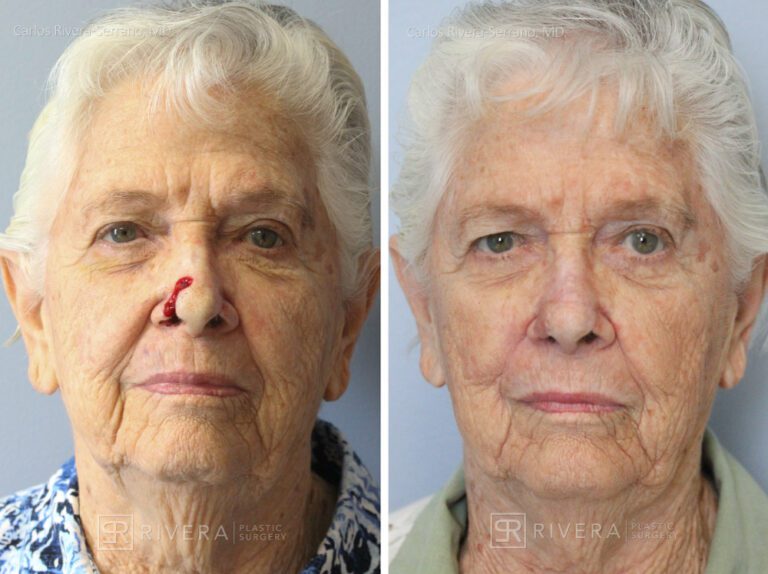 Nasal reconstruction from skin cancer removal with Melolabial flap - Woman - Case 16525 - Before and after - Frontal view