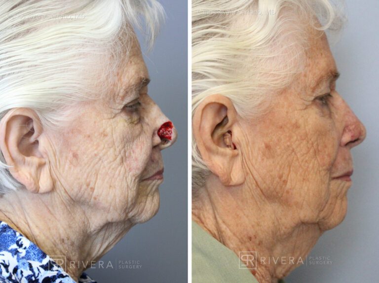 Nasal reconstruction from skin cancer removal with Melolabial flap - Woman - Case 16525 - Before and after - Lateral view