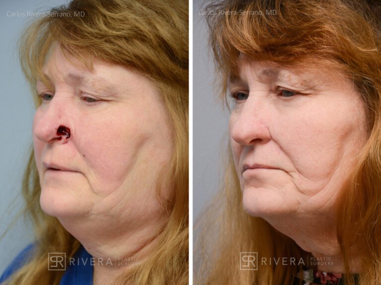 Nasal reconstruction from skin cancer removal with Melolabial flap - Woman - Case 16528 - Before and after - Oblique view