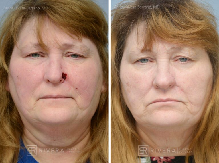 Nasal reconstruction from skin cancer removal with Melolabial flap - Woman - Case 16528 - Before and after - Frontal view