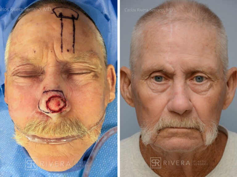Nasal reconstruction from skin cancer removal with Paramedian Forehead flap - Man - Case 16529 - Before and after - Frontal view