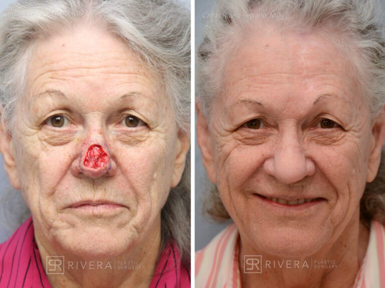 Nose reconstruction from skin cancer removal with Paramedian Forehead flap Miami- Woman - Case 16503 - Before and after - Frontal view