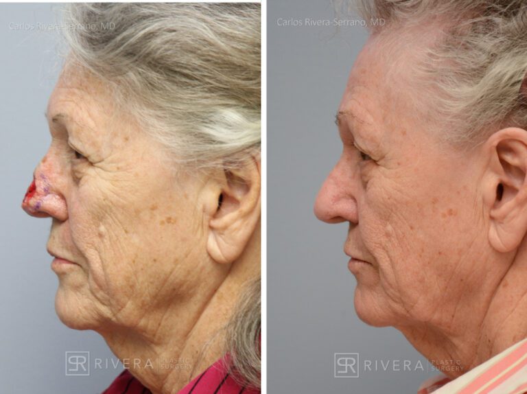 Nose reconstruction from skin cancer removal with Paramedian Forehead flap Miami- Woman - Case 16503 - Before and after - Lateral view