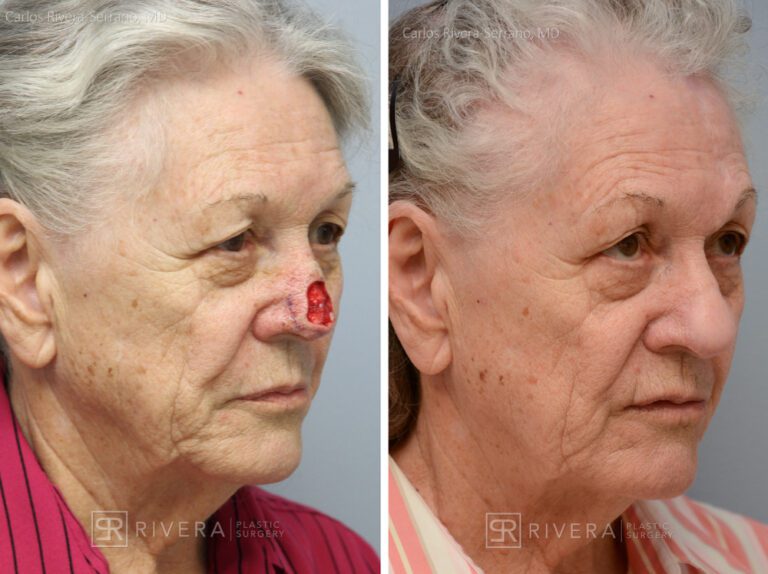 Nose reconstruction from skin cancer removal with Paramedian Forehead flap Miami- Woman - Case 16503 - Before and after - Oblique view
