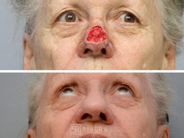 Nose reconstruction from skin cancer removal with Paramedian Forehead flap Miami- Woman - Case 16503 - Before and after - Inferior view