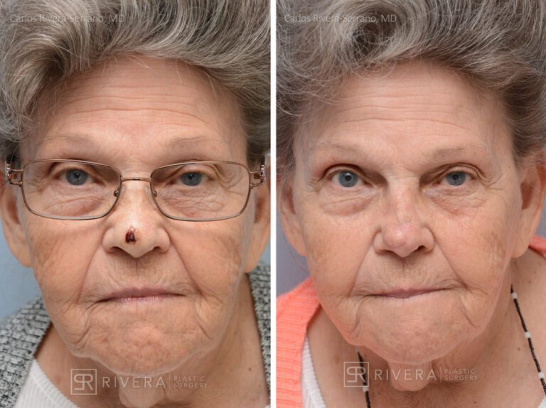 Nasal reconstruction from skin cancer removal with Bilobed Rotational flap - Woman - Case 16533 - Before and after - Frontal view