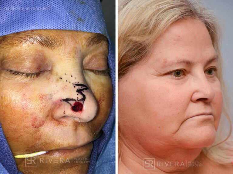 Nasal reconstruction from skin cancer removal with Bilobed Rotational flap - Woman - Case 16534 - Before and after - Oblique view