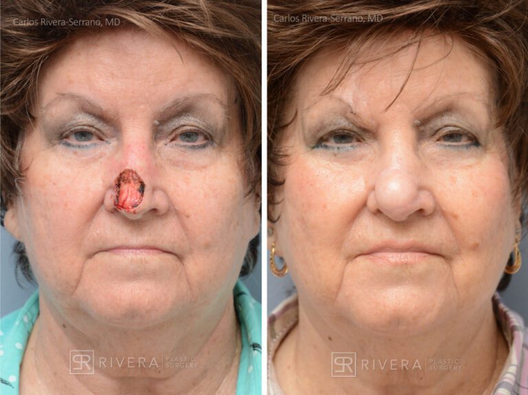 Nose reconstruction from skin cancer removal with Paramedian Forehead flap - Woman - Case 16504 - Before and after - Frontal view