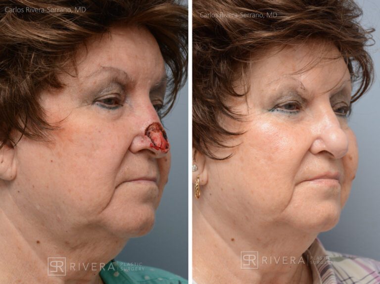 Nose reconstruction from skin cancer removal with Paramedian Forehead flap - Woman - Case 16504 - Before and after - Oblique view