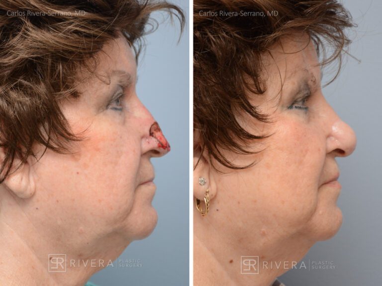 Nose reconstruction from skin cancer removal with Paramedian Forehead flap - Woman - Case 16504 - Before and after - Lateral view