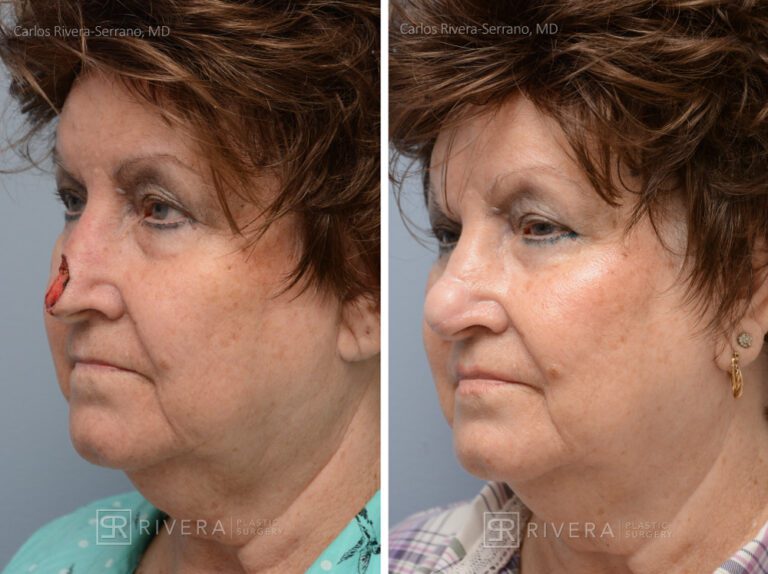Nose reconstruction from skin cancer removal with Paramedian Forehead flap - Woman - Case 16504 - Before and after - Oblique view