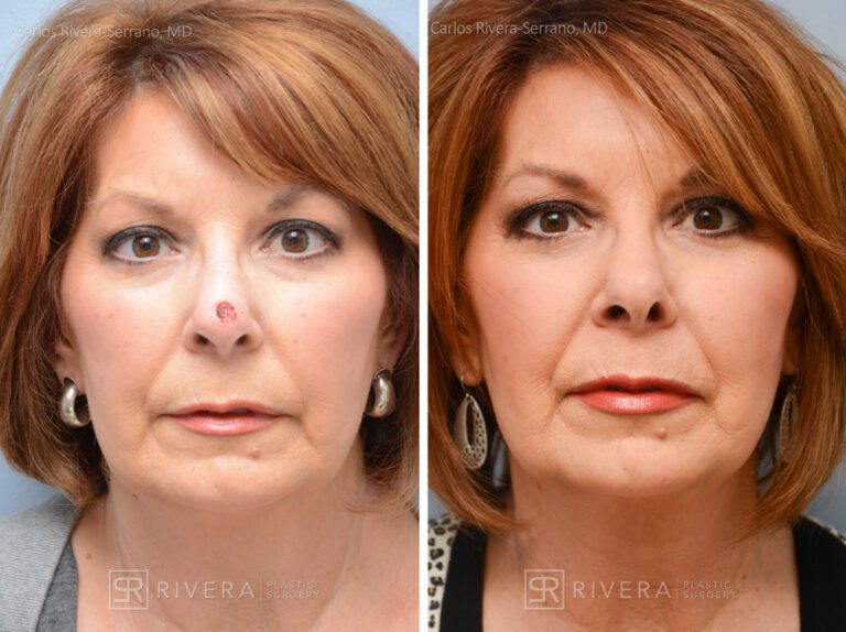 Nose reconstruction from skin cancer removal with Bilobed Rotational flap - Woman - Case 16505 - Before and after - Frontal view