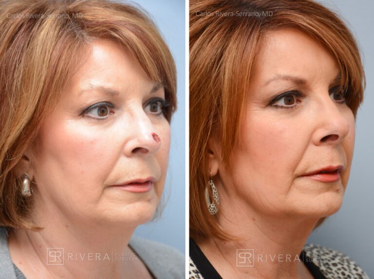 Nose reconstruction from skin cancer removal with Bilobed Rotational flap - Woman - Case 16505 - Before and after - Oblique view