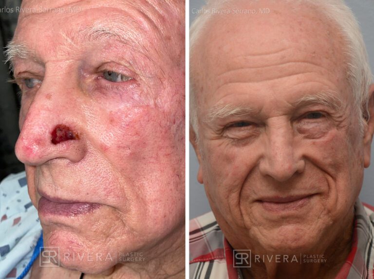 Nose reconstruction from skin cancer removal with Bilobed Rotational flap - Man - Case 16506 - Before and after - Oblique view