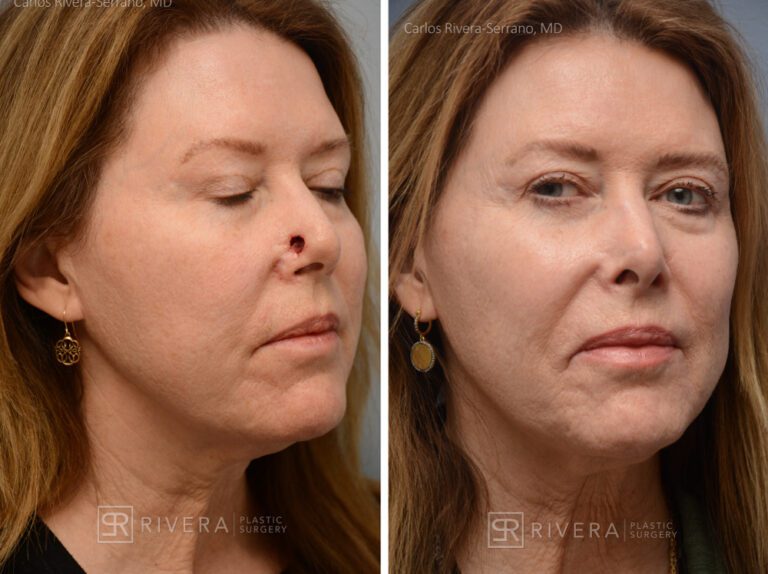 Nose reconstruction from skin cancer removal with Bilobed Rotational flap - Woman - Case 16507 - Before and after - Oblique view
