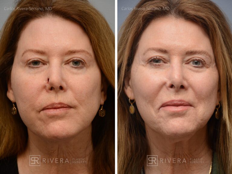 Nose reconstruction from skin cancer removal with Bilobed Rotational flap - Woman - Case 16507 - Before and after - Frontal view