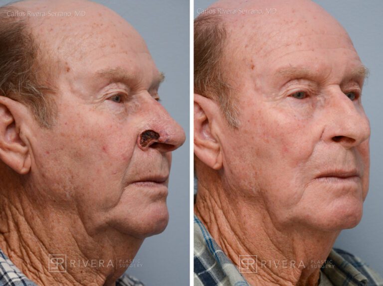 Nose reconstruction from skin cancer removal with Melolabial flap - Man - Case 16508 - Before and after - Oblique view