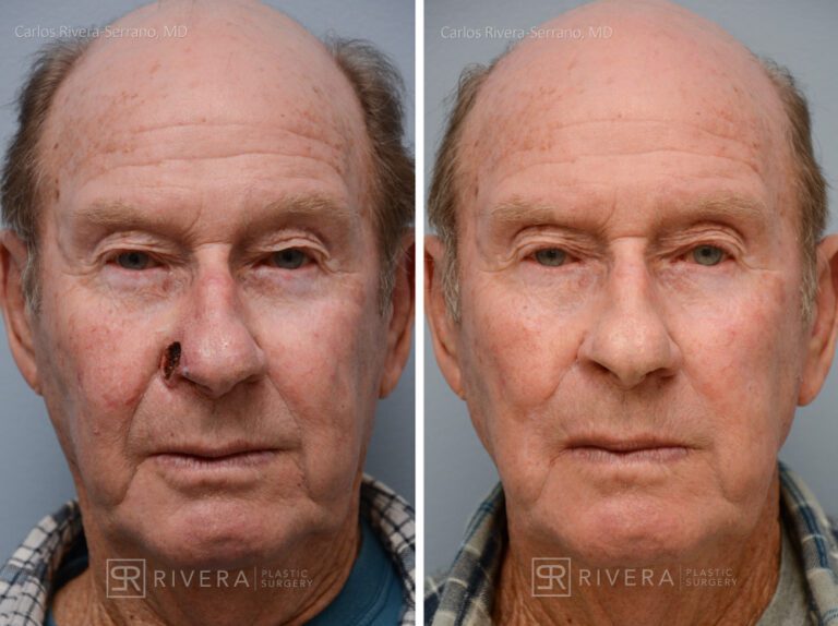 Nose reconstruction from skin cancer removal with Melolabial flap - Man - Case 16508 - Before and after - Oblique view
