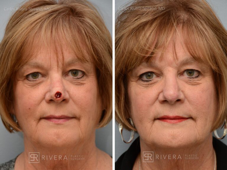 Nose reconstruction from skin cancer removal with Dorsal Sliding Advancement flap - Woman - Case 16509 - Before and after - Frontal view
