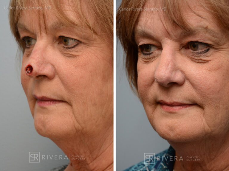 Nose reconstruction from skin cancer removal with Dorsal Sliding Advancement flap - Woman - Case 16509 - Before and after - Oblique view