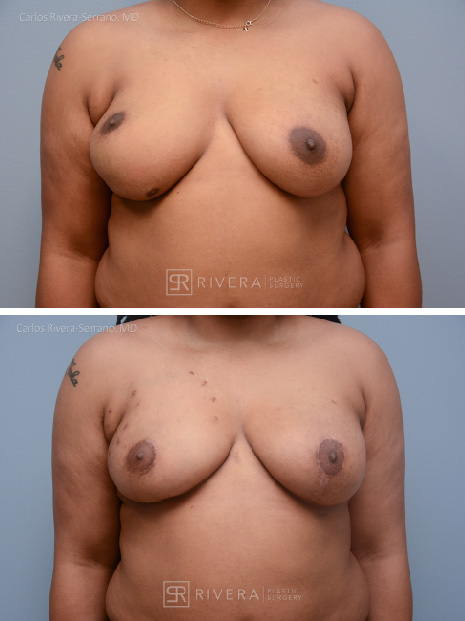 potrait breastaugmentationwithfattransfer case1 dr carlos rivera serrano