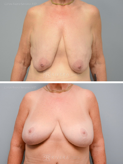 Breast lift surgery woman - Breast lift - Breast - Before and after case 1 - Frontral view
