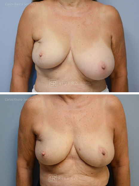 Breast lift surgery woman - Breast lift - Breast - Before and after case 2 - Frontal view