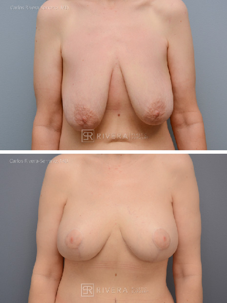 Breast lift surgery woman - Breast lift - Breast - Before and after case 4 - Frontal view