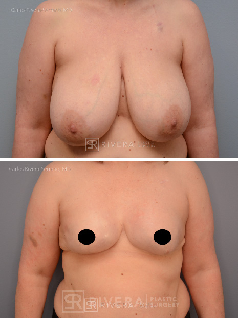 potrait breastreconstruction case6 dr carlos rivera serrano