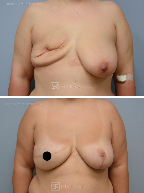 potrait breastreconstruction case8 dr carlos rivera serrano