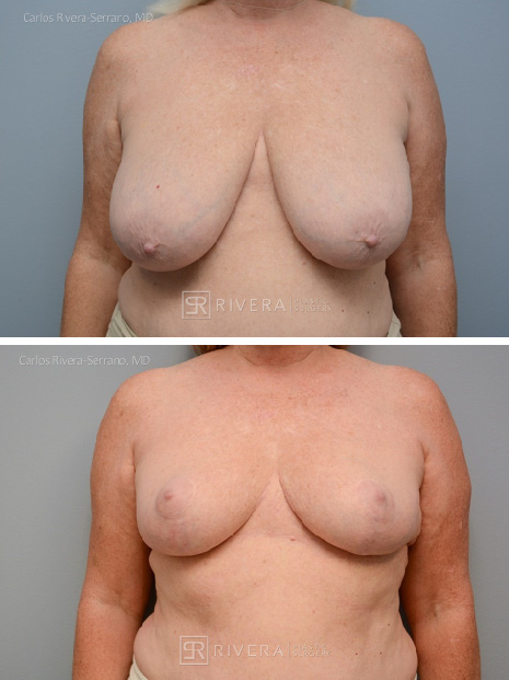 potrait breastreduction case1 dr carlos rivera serrano
