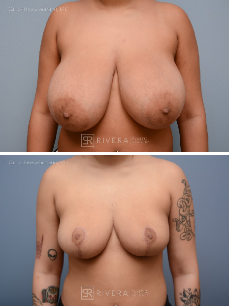potrait breastreduction case10 dr carlos rivera serrano