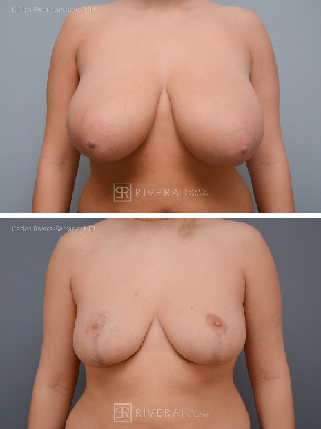 potrait breastreduction case11 dr carlos rivera serrano