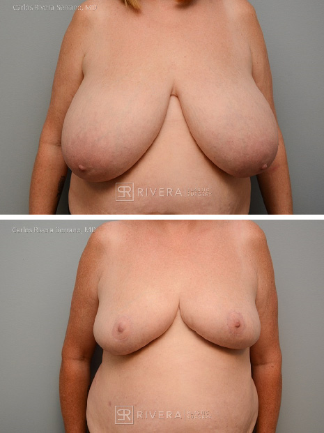 potrait breastreduction case14 dr carlos rivera serrano