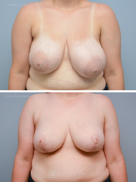 potrait breastreduction case15 dr carlos rivera serrano