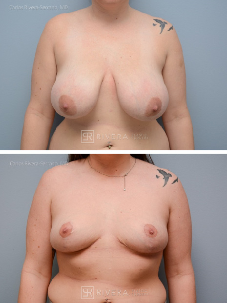 potrait breastreduction case16 dr carlos rivera serrano